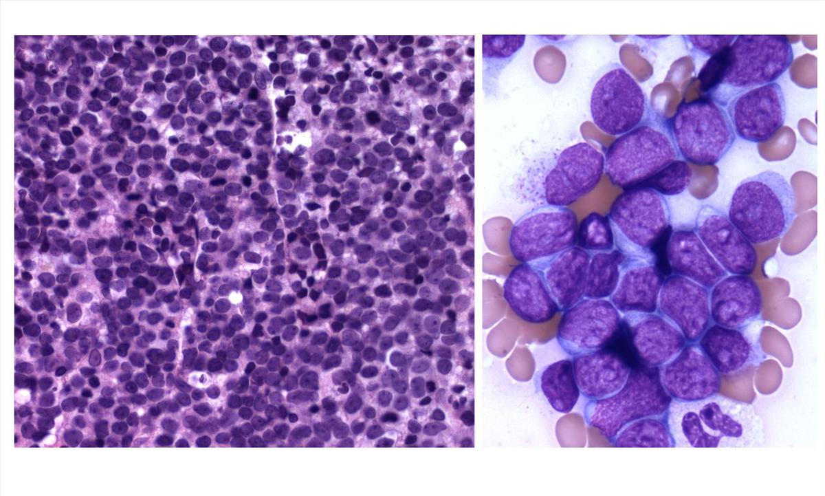 Aspirate smear and trephine biopsy